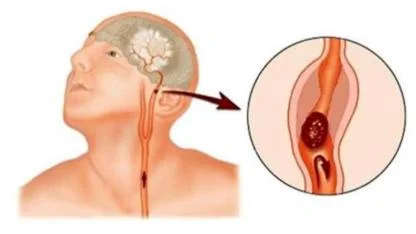 Bayburt İl Sağlık Müdürlüğü’nden hayati uyarı!