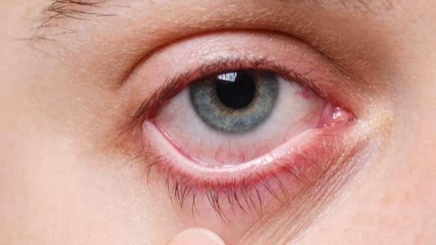 Kışla birlikte gelen göz enfeksiyonlarına dikkat